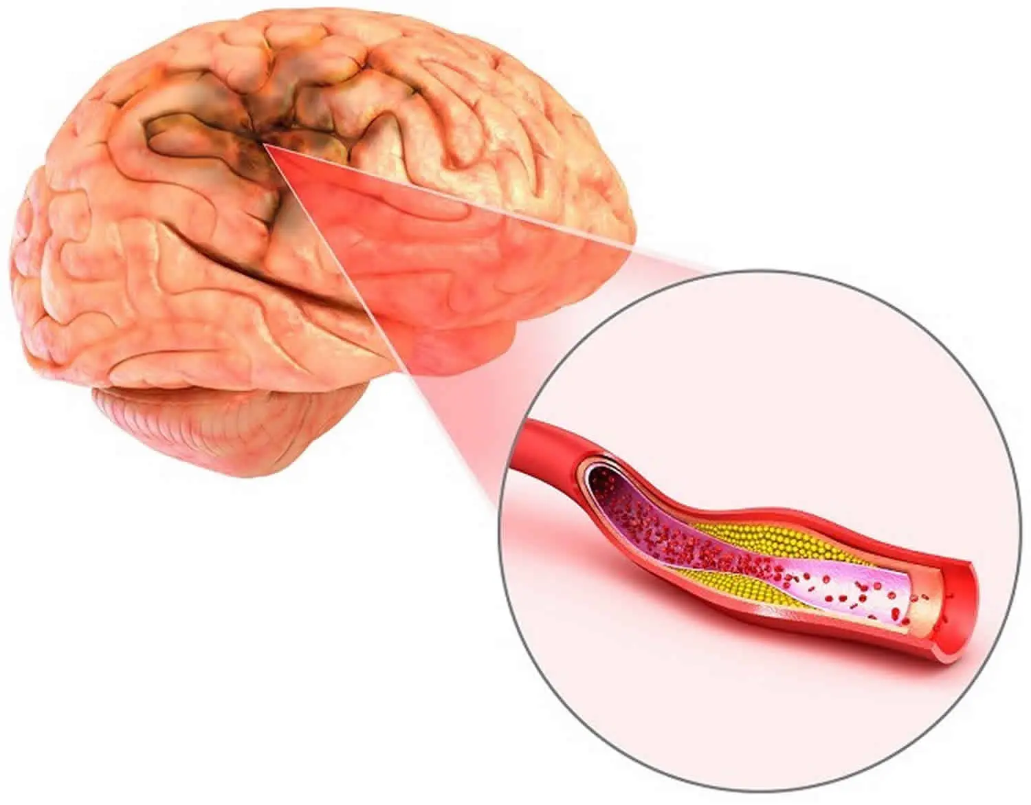 Atherosclerosis of cerebral vessels in adults