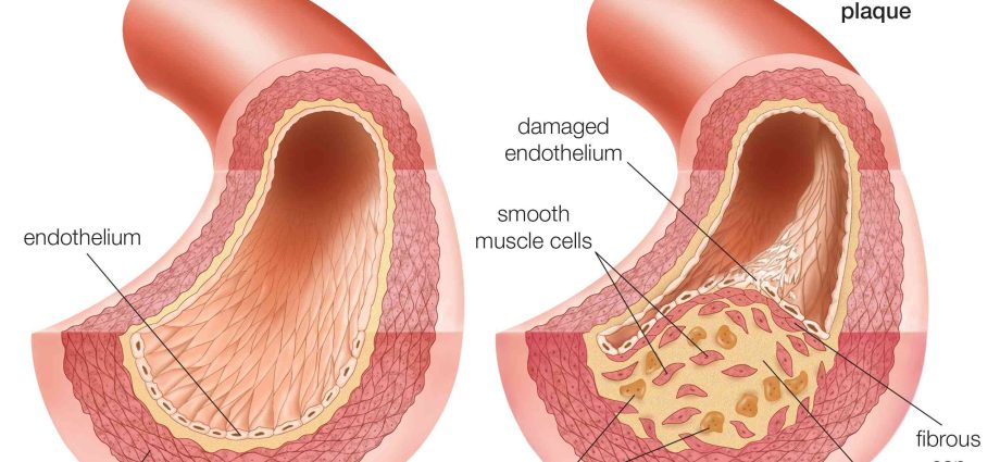 Atherosclerosis of the aorta of the heart in adults