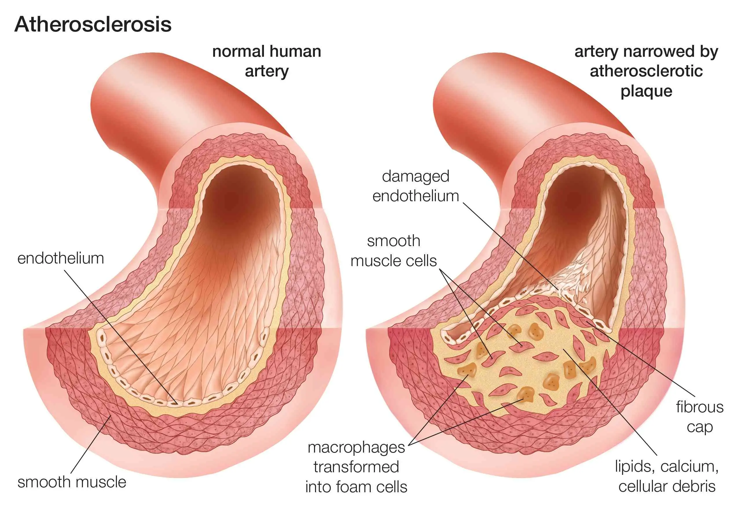 Atherosclerosis of the aorta of the heart in adults