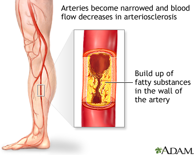 Atherosclerosis of the vessels of the lower extremities in adults