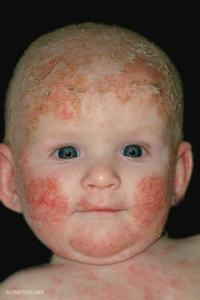 Atopic dermatitis in children