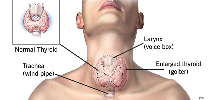 Autoimmune thyroiditis in adults