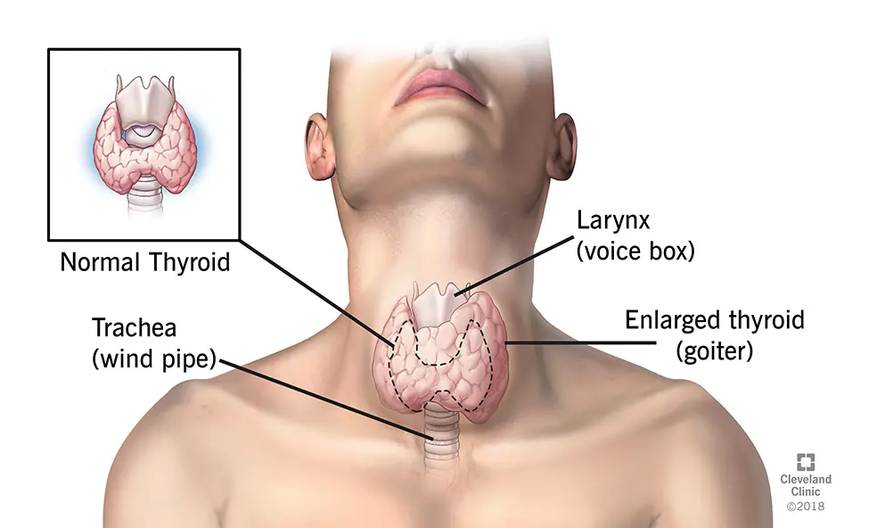 Autoimmune thyroiditis in adults