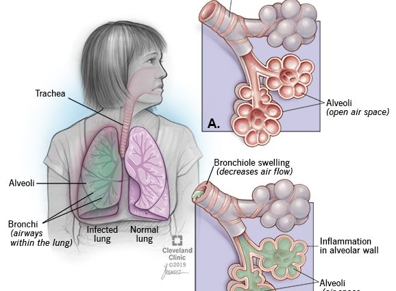 Bacterial pneumonia in adults