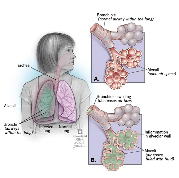 Bacterial pneumonia in adults