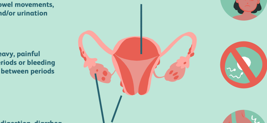 Geriausi moterų endometrito gydymo būdai
