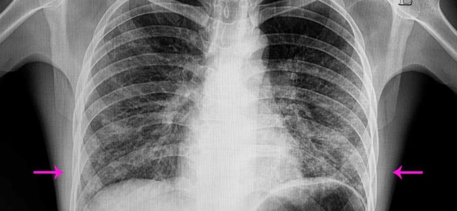 Bilateral pneumonia in adults