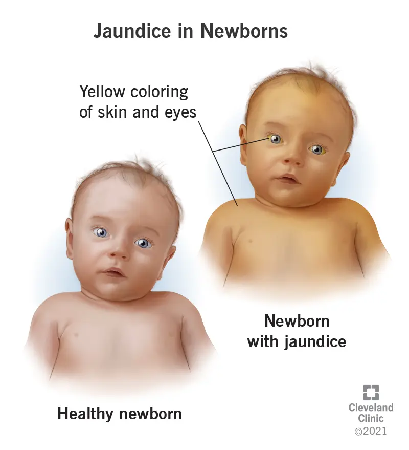 Bilirubin in newborns