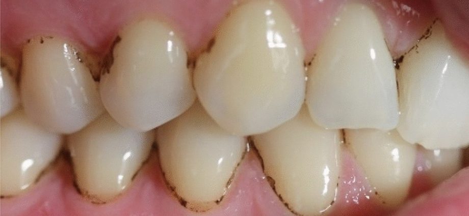 Black plaque on the teeth in adults