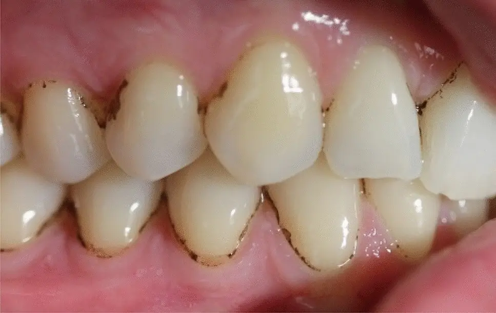 Black plaque on the teeth in adults