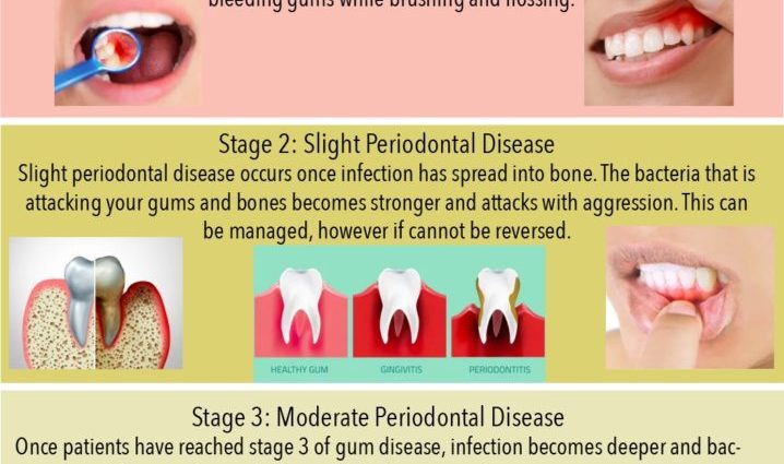 Bleeding gums in adults