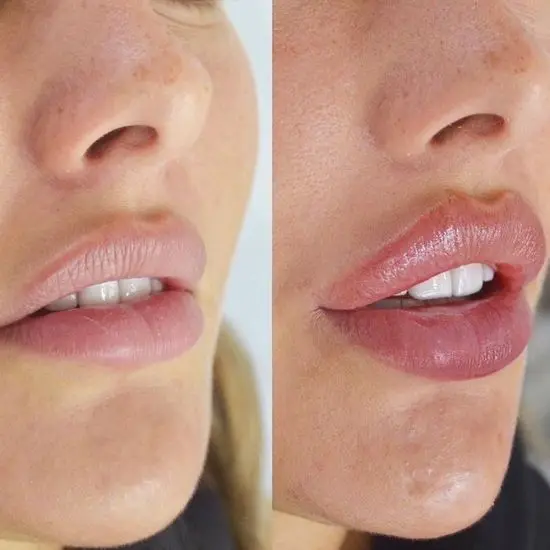 Botox lips