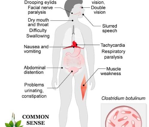 Botulism in adults