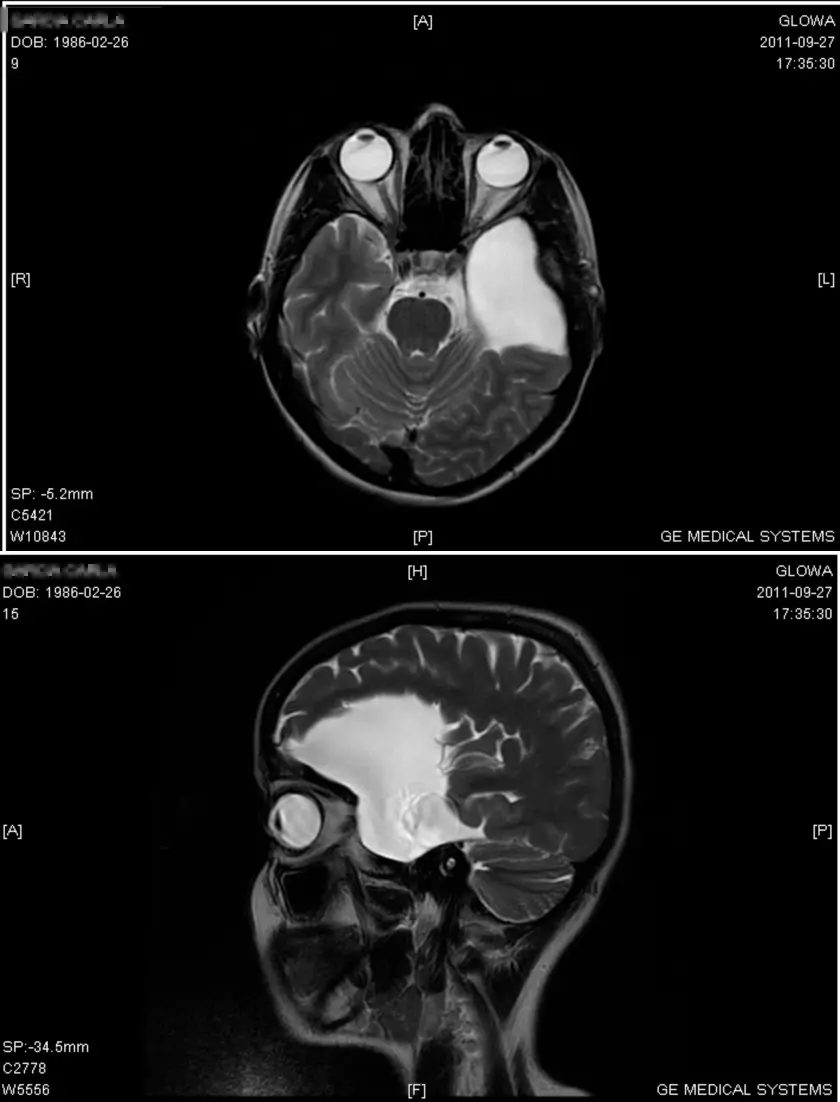 Brain cyst in adults