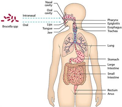 brucellosis in humans