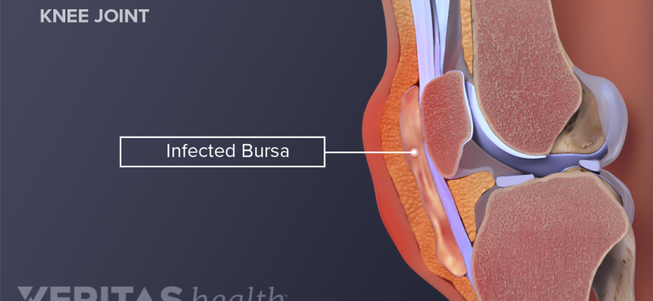 Bursitis of the knee joint in adults