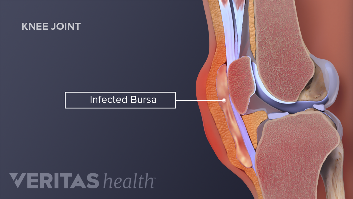 Bursitis de la articulación de la rodilla en adultos Comida saludable