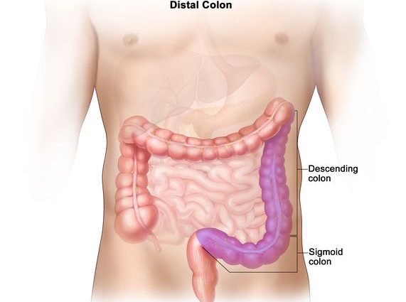 Kanseran'ny colon sigmoid