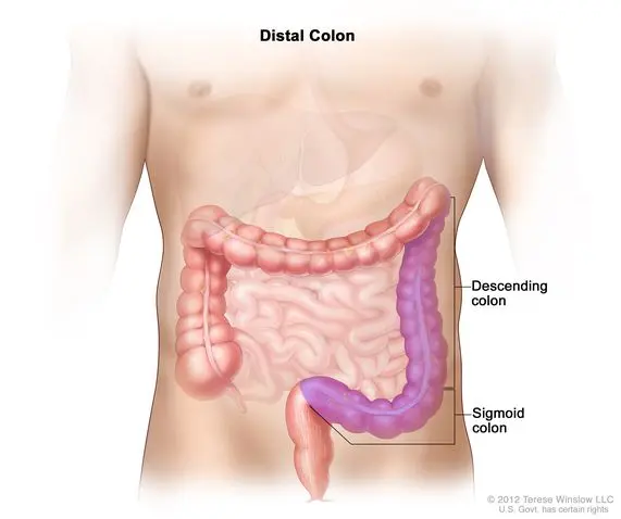 Cancer of the sigmoid colon