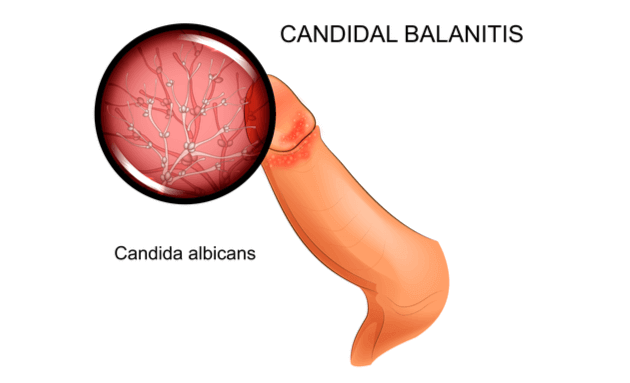 candidiasis in men