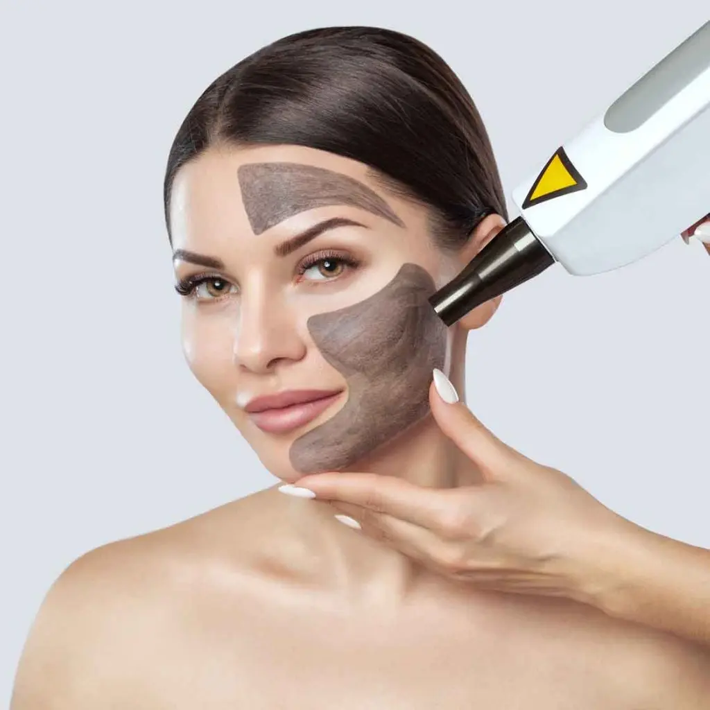 Carbon face peel