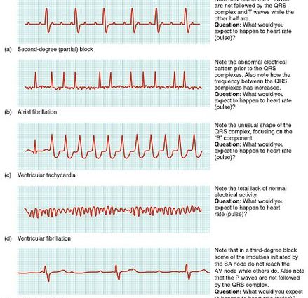 Cardiac arrhythmia in adults