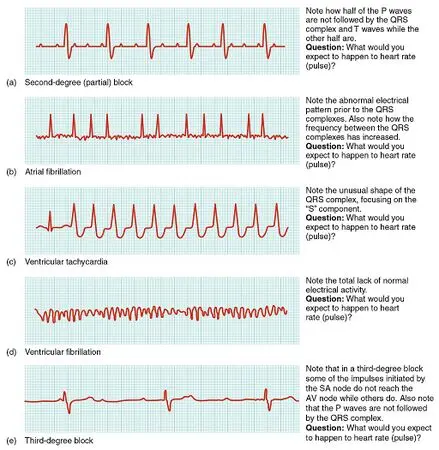 Cardiac arrhythmia in adults