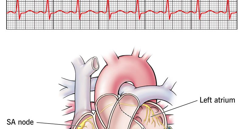 Cardiac tachycardia in adults