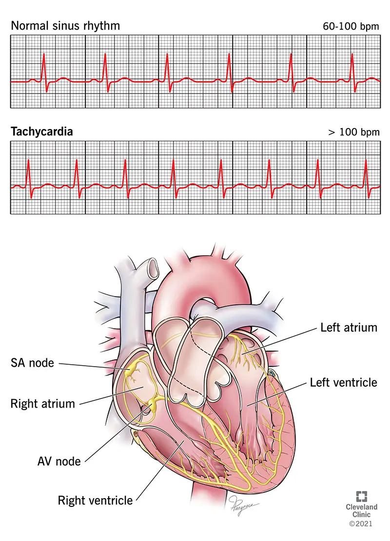 Cardiac tachycardia in adults