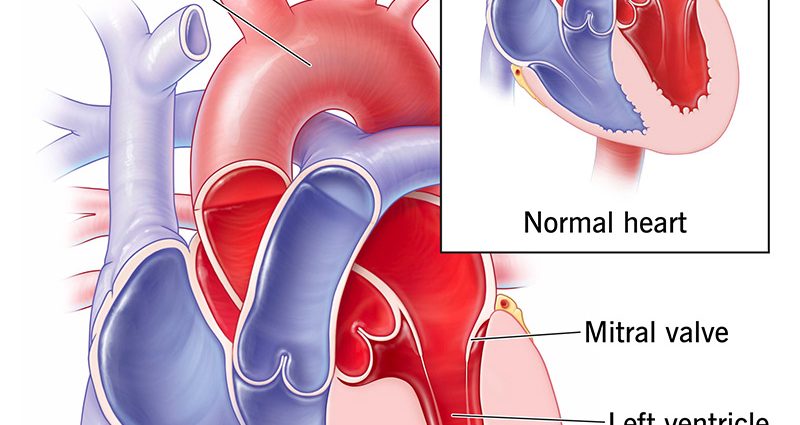 Cardiomyopathy of the heart in adults