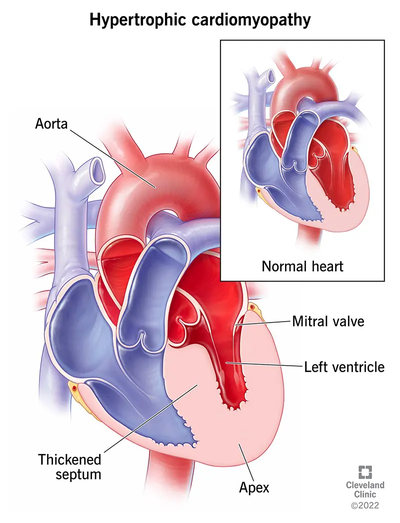 Cardiomyopathy of the heart in adults