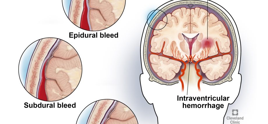 Cerebral hemorrhage in adults