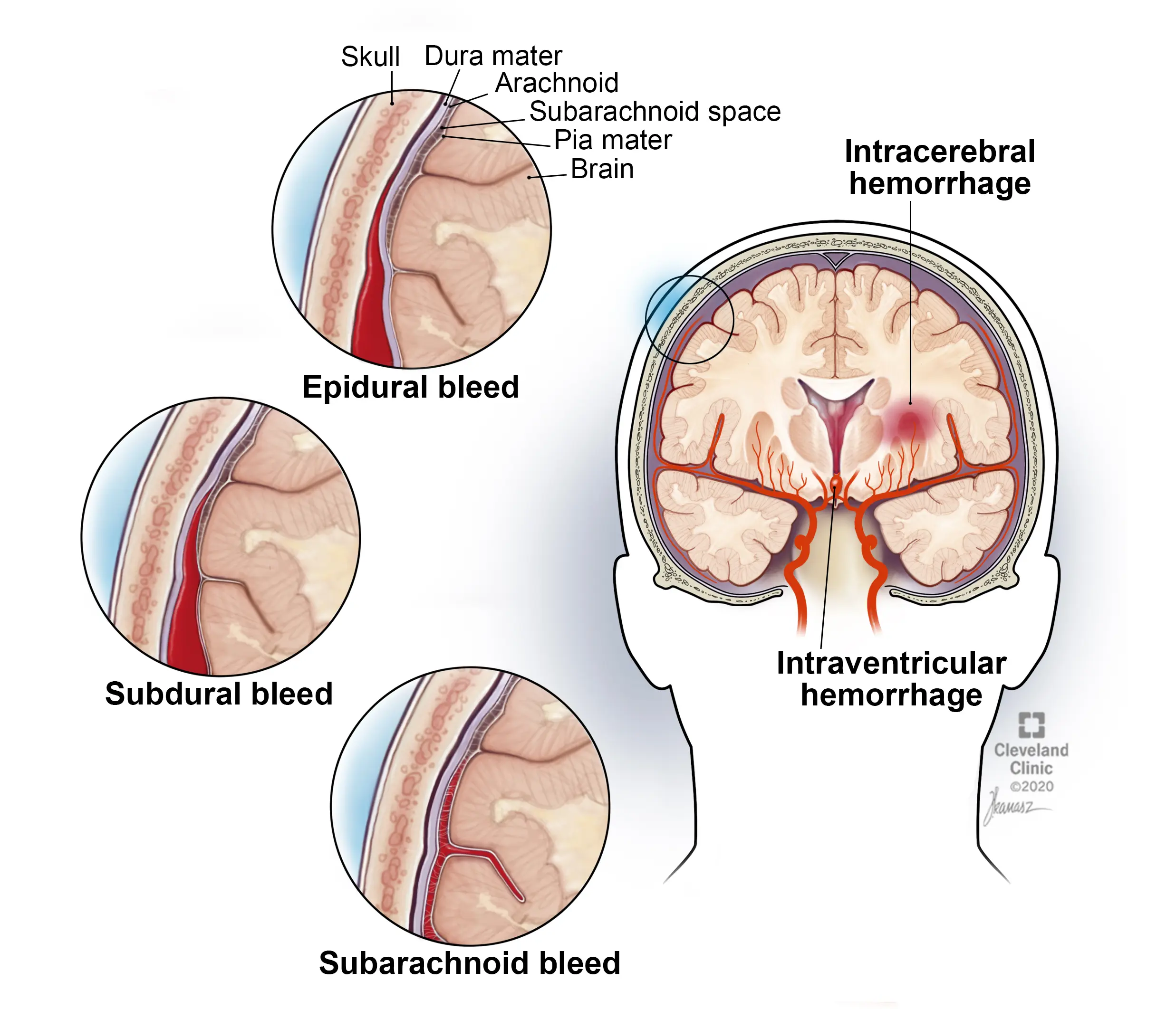 Cerebral hemorrhage in adults