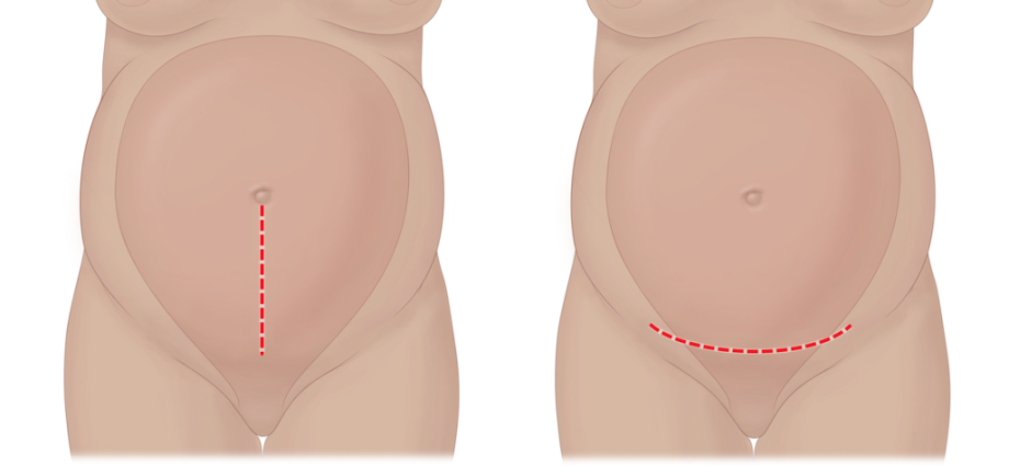 Cesarean section