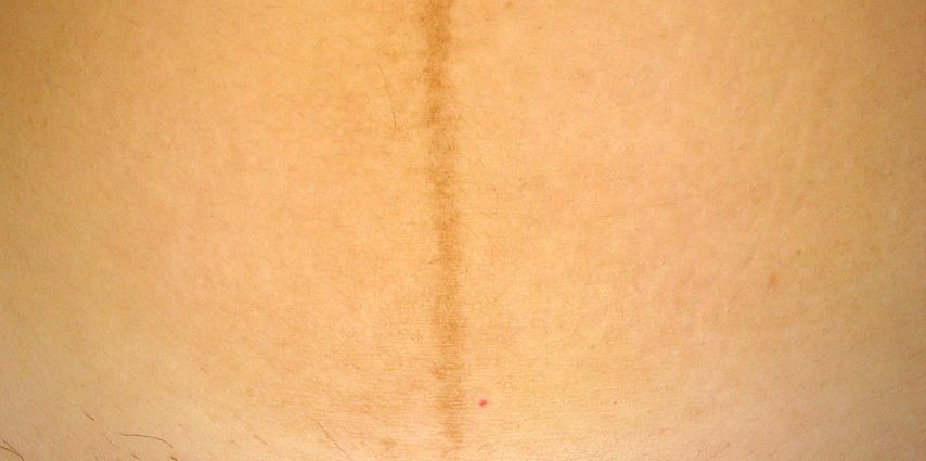 Cesarean section scar