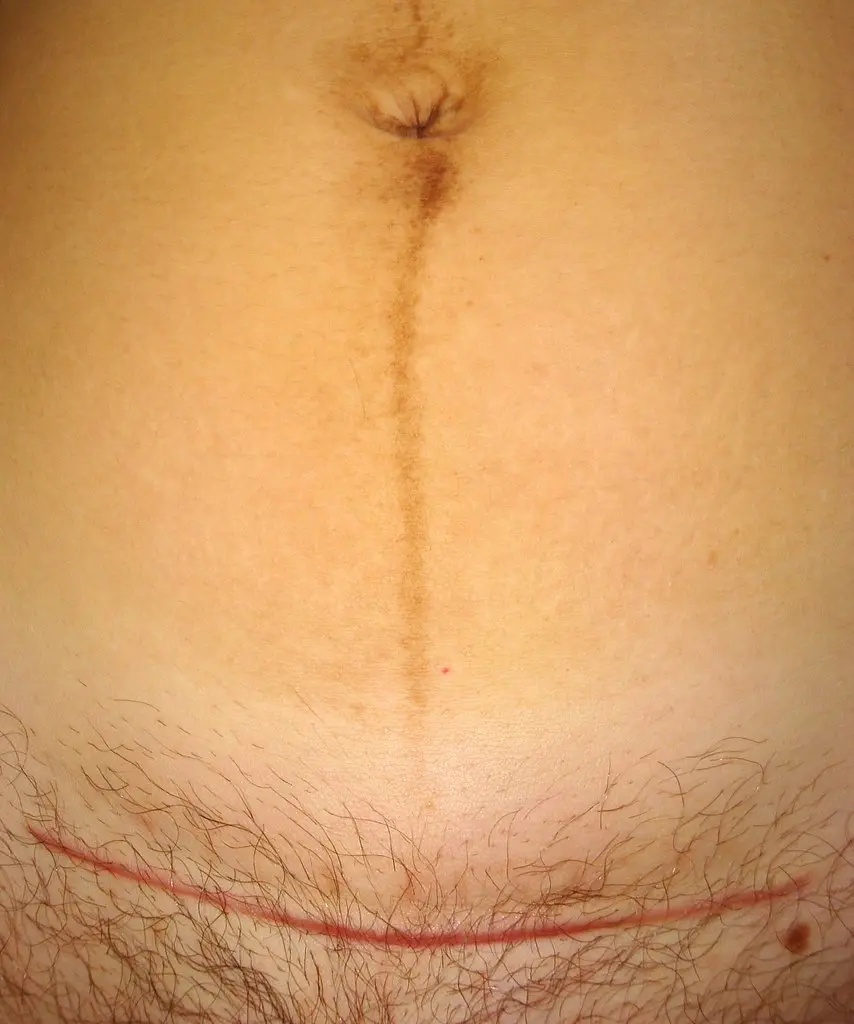 Cesarean section scar