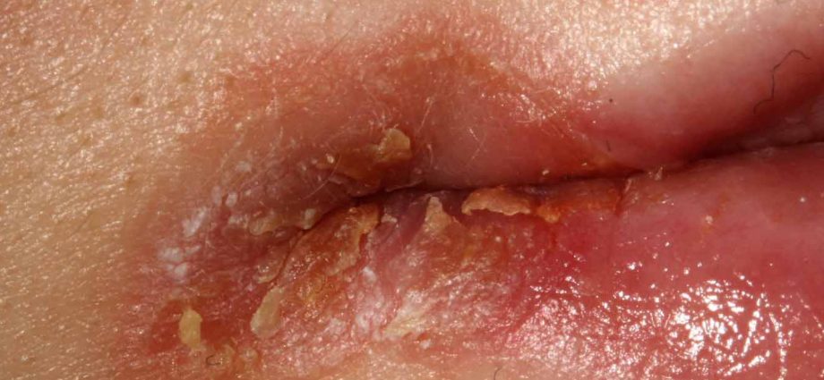 Cheilitis in adults