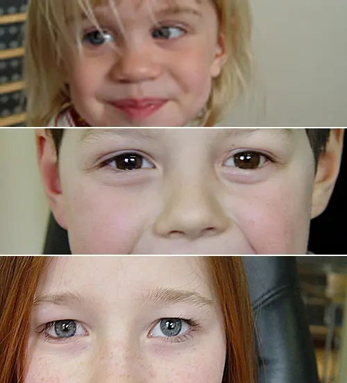 Child&#8217;s eyes fester