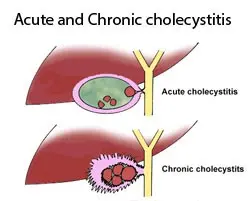 Chronic acalculous cholecystitis