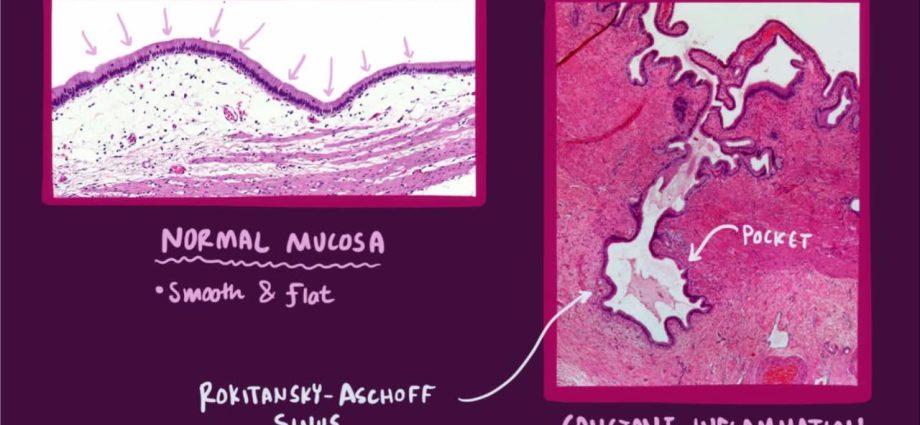 Chronic cholecystitis