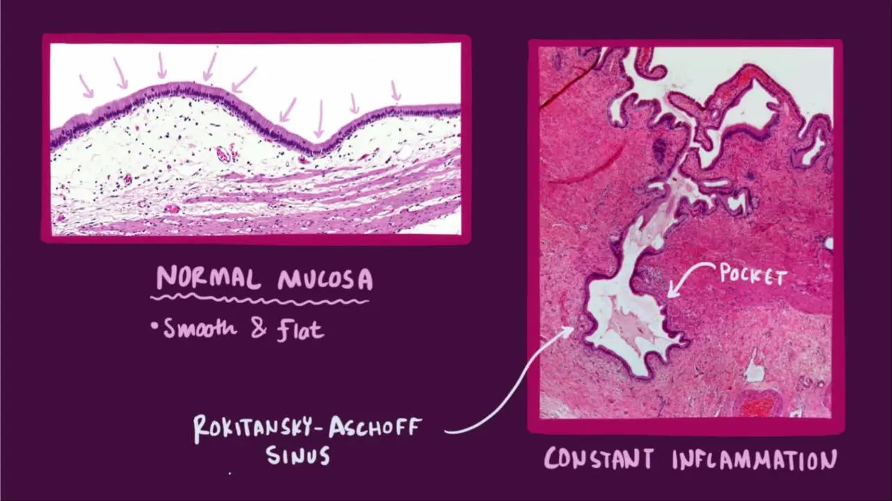 Chronic cholecystitis