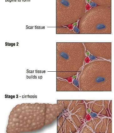 chronic hepatitis