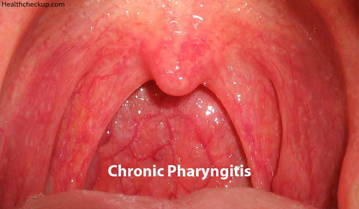 Chronic pharyngitis in adults