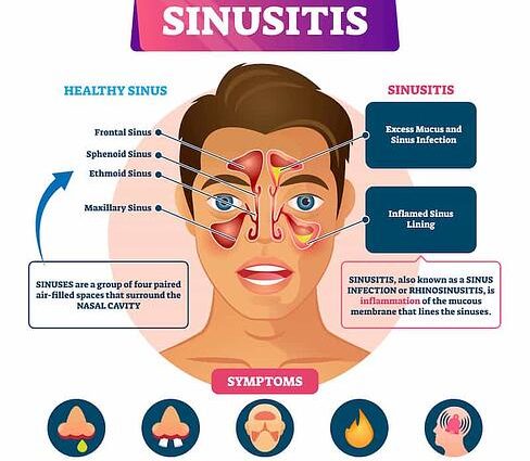 Chronic sinusitis in adults