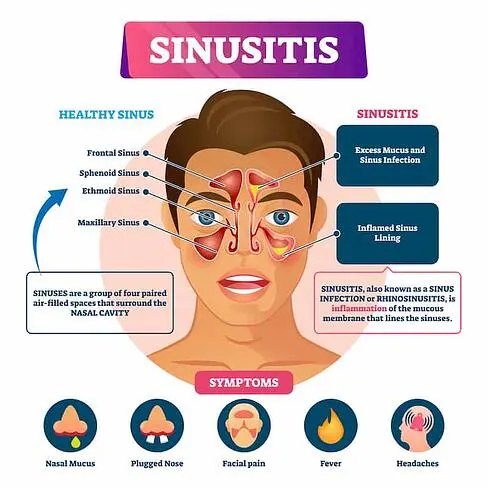 Chronic sinusitis in adults