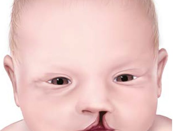 Rascjep usne kod djece