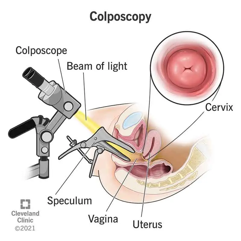 Colposcopy of the cervix