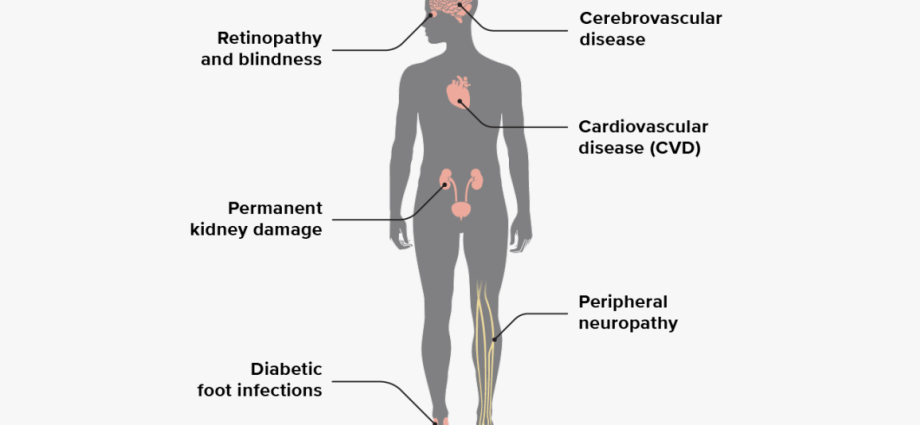 Complications in type 2 diabetes