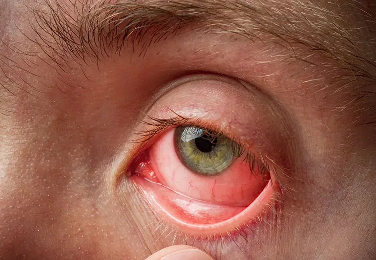 Conjunctivitis in adults