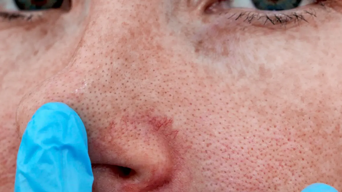 Couperose on the face